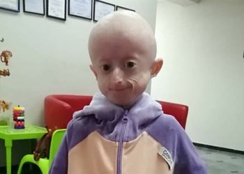 زارۆكه‌كا 10 سالى ب ئه‌گه‌رێ پیربوونا پێشوه‌خت وه‌غه‌ر كر