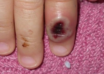 ل بریتانیا نه‌خۆشییه‌كا مه‌ترسیدار به‌لاڤبوویه‌