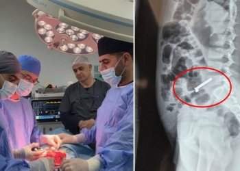 ل هەولێرێ 20 موگناتیس ڕیڤیكێن زارۆكەكیدا هاتنە دەرخستن