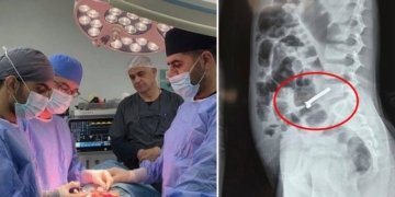 ل هەولێرێ 20 موگناتیس ڕیڤیكێن زارۆكەكیدا هاتنە دەرخستن